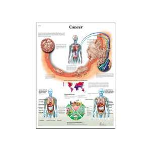  Laminated Paper Cancer Anatomical Chart (Cancer Anatomical Chart 