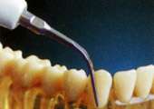 To remove the calculus of supragingival, subgingival and interdental 